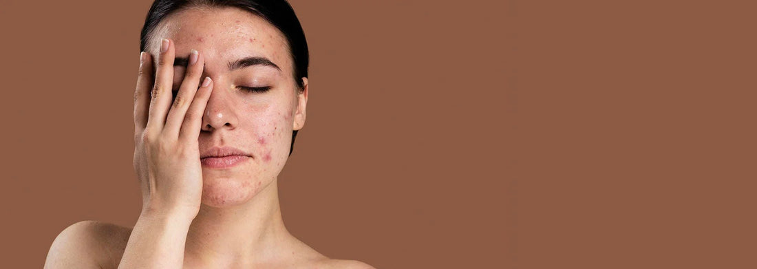 Woman with acne-prone skin touching forehead, showcasing skincare concern for targeted treatment